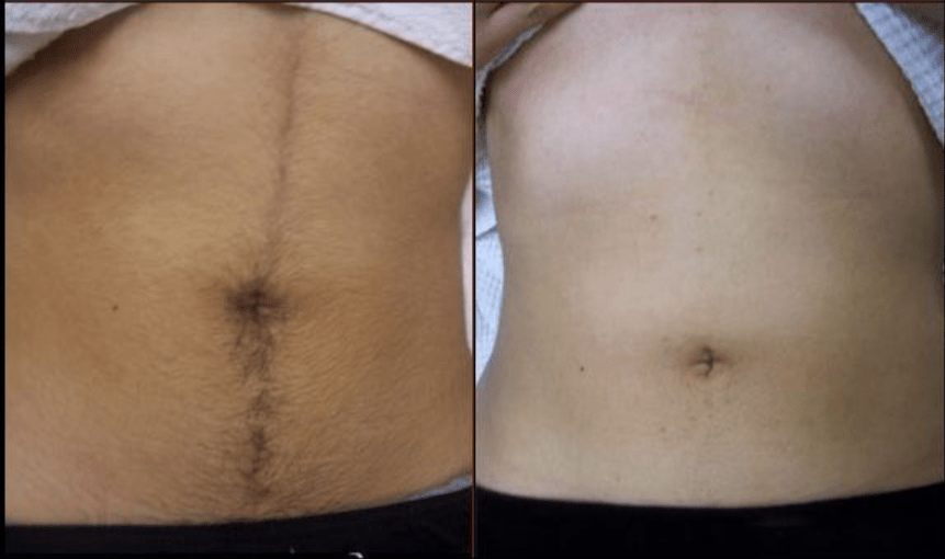 epilation-before-after_-1-thousand-results-found-in-Yandex-Images.png