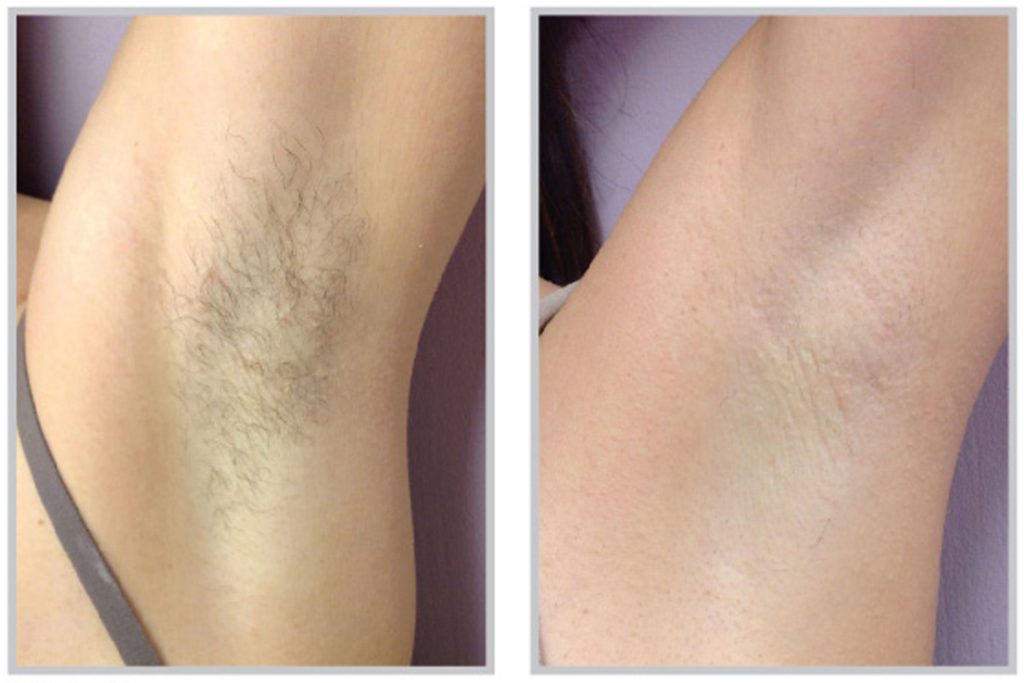synergy_before-after-laser-hair-removal-female-male-armpits-back-face-1-1024x683-1.jpg